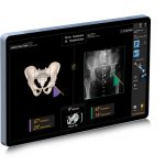 computer-guided-surgery-with-smith+nephew’s-hip-replacement-implants-shown-to-significantly-improve-survivorship-and-increase-patient-satisfaction-compared-to-conventional-surgery