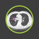 optellum-announces-strategic-collaboration-with-the-lung-cancer-initiative-at-johnson-&-johnson,-applying-ai-to-transform-early-lung-cancer-treatment